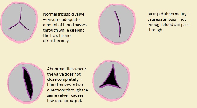 Tricuspid valve abnormalities